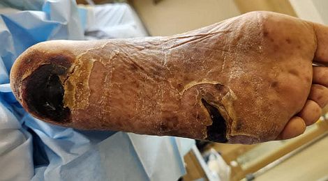 GANGRENE ON FOOT